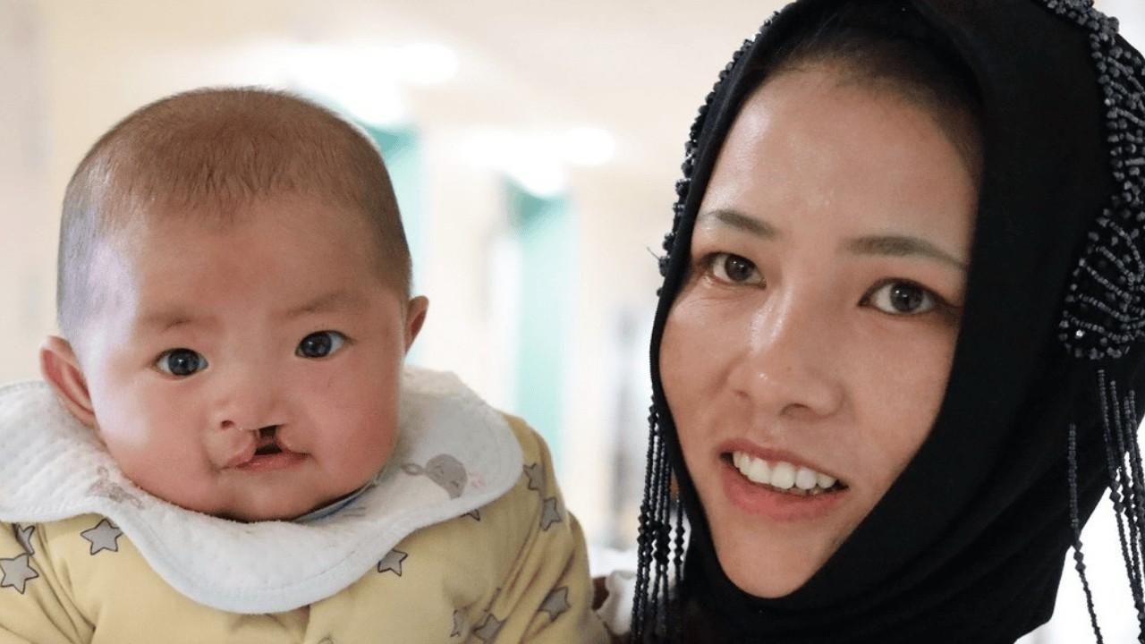 A mother holding her baby with a cleft lip.