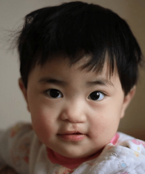 Toddler girl with a cleft lip repair smiles inquisitively at the camera