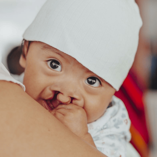 A little baby in China with a bilateral cleft lip and palate.