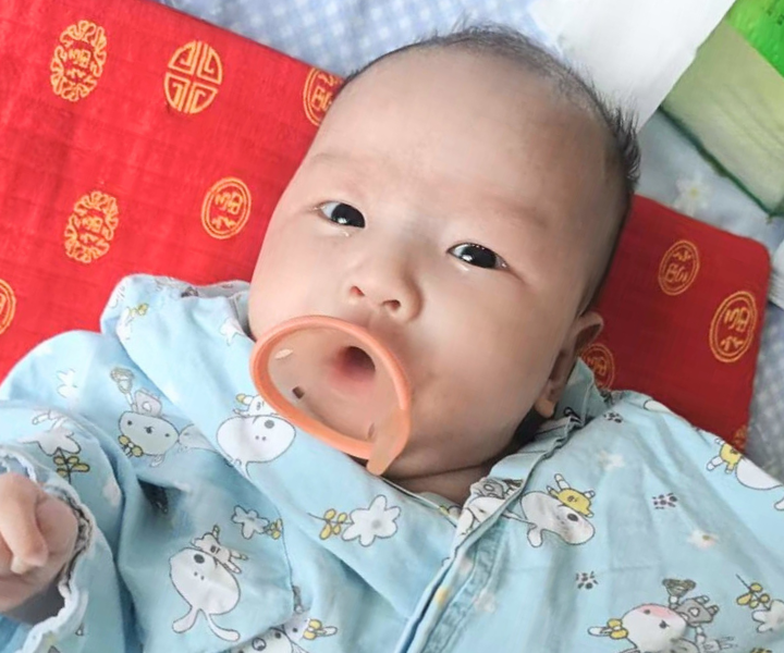 A baby girl from China is in a hospital gown and sucks on a pacifier with tears in her eyes. She will be receiving heart surgery through LWB's cardiac program.