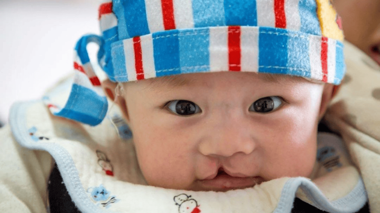 A baby with a cleft lip is wearing a red, white, and blue hat and bib.